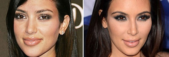 25 fotos de celebridades que se operaron la nariz