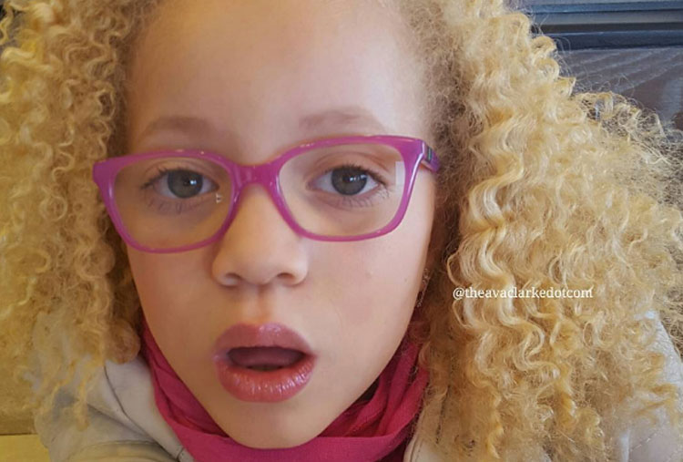 Los africanos albinos son marginados