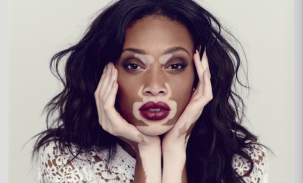 Winnie Harlow